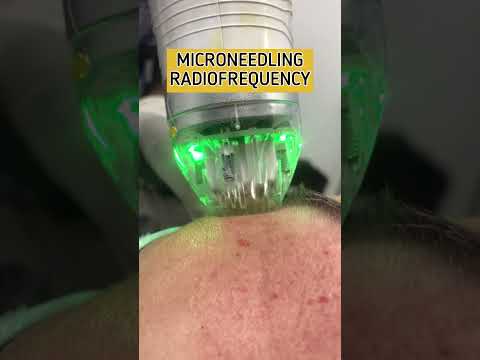 How to get rid of PORES on face | LARGE PORES treatment | Open Pores treatment #skincare #openpores